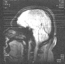 Bran's MRI.